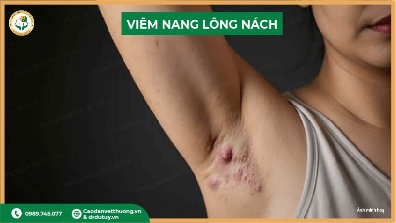 viem-nang-long-nach (2)